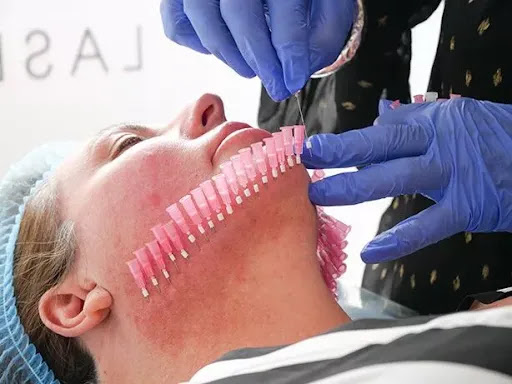 SILK Laser Clinics Castletown Townsville - Thumbnail