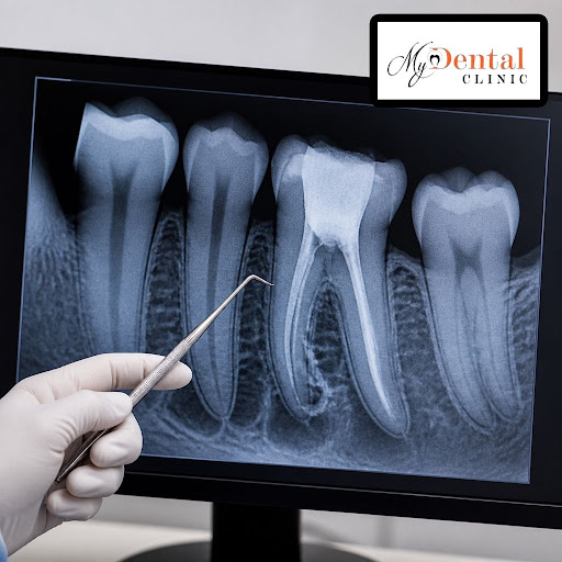 Not all root canals heal as expected, but that doesn’t mean you must lose your tooth. At My Denta… post image