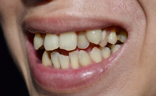 Are you struggling with crowded teeth? Dr. Nilesh Khandare, a recognized expert in dentistry base… post image