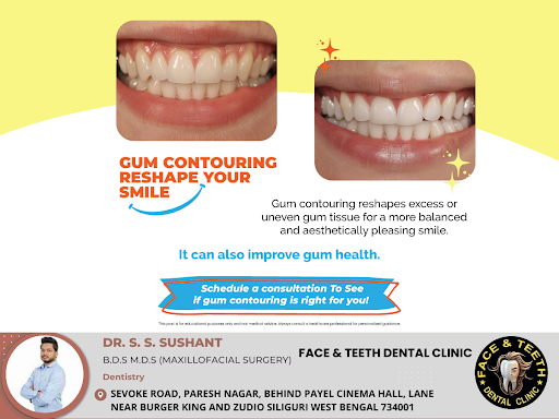 Gum contouring is a cosmetic procedure that reshapes uneven or excess gum tissue, creating a more… post image