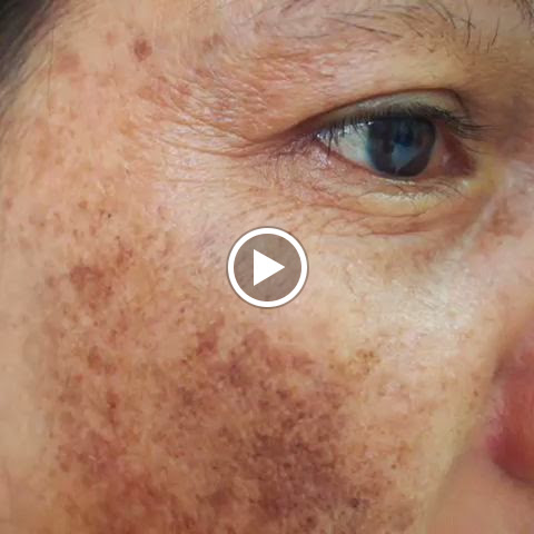 Skin whitening -त्वचा के कलर मे निखार पायें, melasma & hyperpigmentation -झईयां, दाग धब्बे मे राह… post image