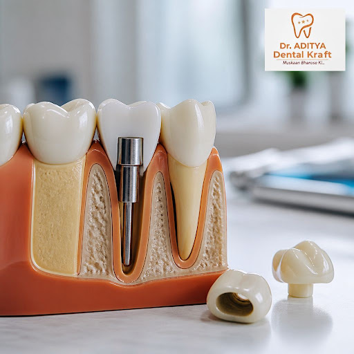 Post and core restorations help rebuild severely damaged teeth so they can support a crown and fu… post image