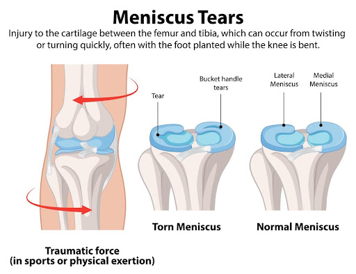 At Sankalp Physical Therapy, a leading Physiotherapy and Rehabilitation clinic in Bangalore, we o… post image