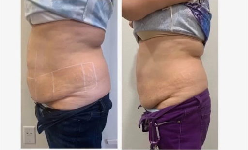 Sculpt Body Contouring and Wellness - Thumbnail