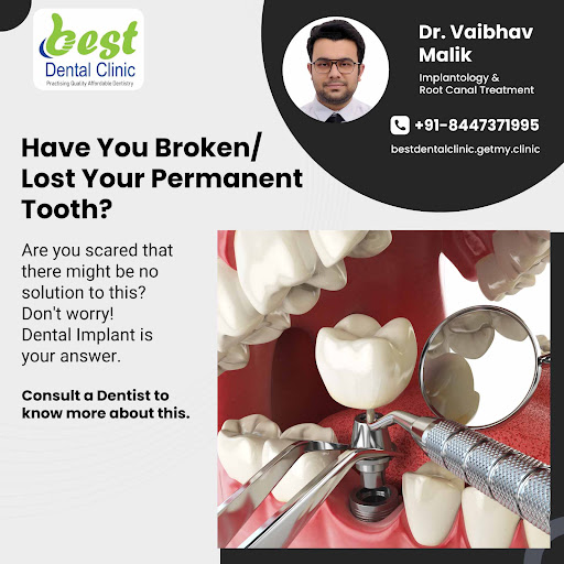 A dental implant (artificial tooth root) is a popular tooth replacement option after tooth loss o… post image