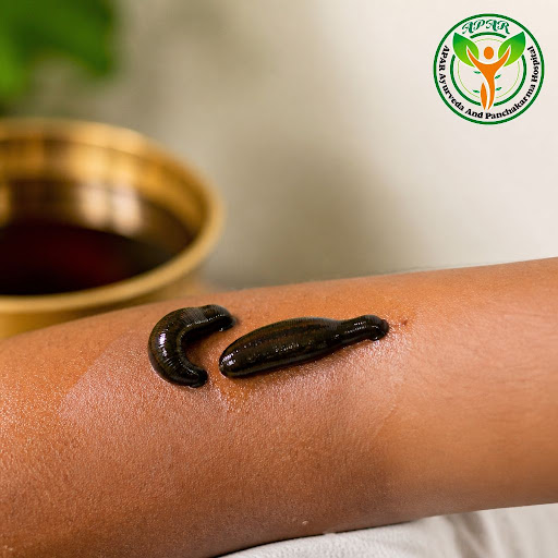 Discover the healing power of traditional Jalaukavacharana at Apar Ayurveda and Panchakarma Hospi… post image