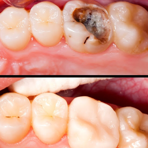 Dental Filling Treatment repairs teeth damaged by decay, small cracks, or wear, so they can chew… post image
