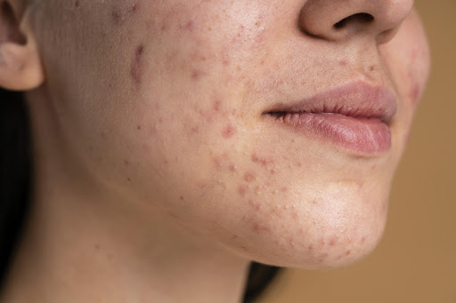 Acne is a common skin condition that can cause pimples, blackheads, whiteheads, and sometimes dee… post image