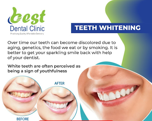 Over time our teeth can become discolored due to aging, genetics, the food we eat, or smoking. It… post image