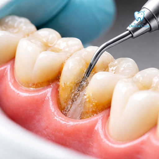 Struggling with bleeding gums, bad breath, or loose teeth? Advanced scaling and root planing at T… post image
