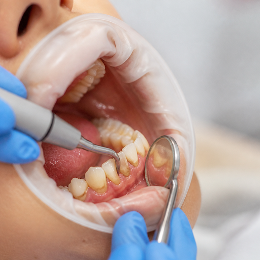 Even with daily brushing and flossing, stubborn plaque and tartar can hide between teeth and alon… post image
