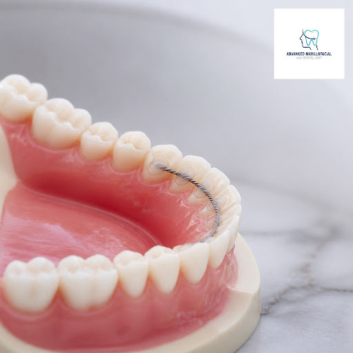 Fixed retainers are the secret to keeping your beautifully aligned smile stable after braces or c… post image