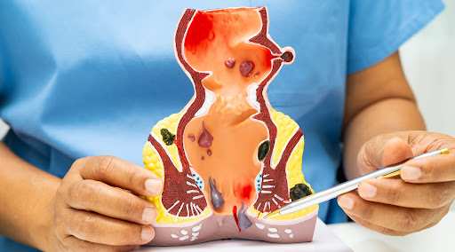 Piles, also known as hemorrhoids, are swollen blood vessels in and around the rectum that can cau… post image