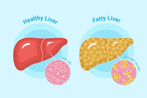 Fatty liver occurs when excess fat builds up in the liver. It can be associated with overweight o… post image