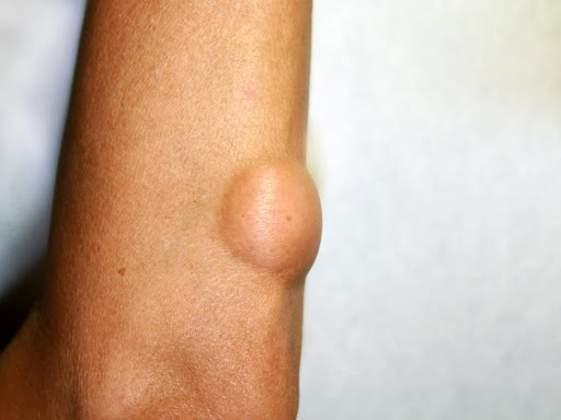 Homeopathic treatment for lipoma post image