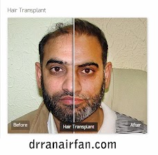 Hair Transplant in Pakistan islamabad