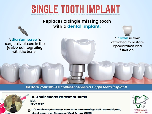 A single tooth implant is a dental procedure used to replace a missing tooth. It involves surgica… post image