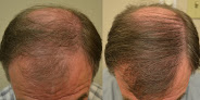 Hair transplant clinic Hair Restoration Of The South in Metairie