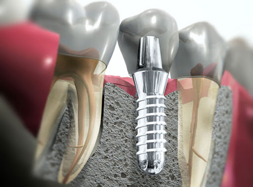 Biodent Napoli - Dr Azzurra Di Cecilia - Invisalign Provider