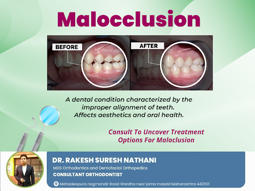 Malocclusion is a dental condition where the teeth and jaws are misaligned, causing issues like d… post image