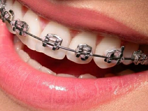 orthodontic braces at very affordable prices...starting from 18000 post image