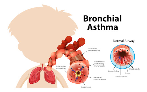 Bronchial asthma can significantly impact daily life, but with the right management plan, patient…