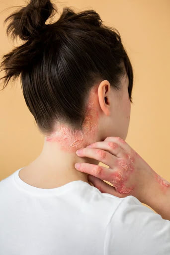 Get expert diagnosis and personalized treatment for psoriasi