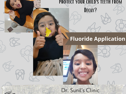 Fluoride application