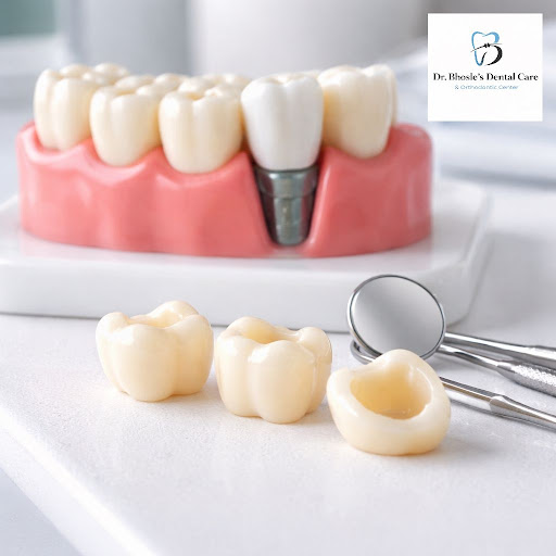 Want a strong, long-lasting and natural-looking solution for damaged or discoloured teeth? At Dr… post image