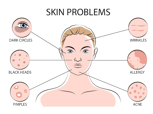 Skin problems have reach to next level and every 3 out of 5 people are having some skin issues. A… post image