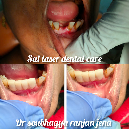 Dental bridge//Rourkela Dental clinic//Sai laser dental care//best service providers//Dental vene… post image