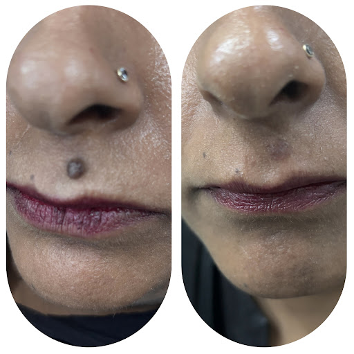 “A mole on the face is usually harmless, but any changes in size, shape, or color should be evalu… post image