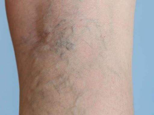 VARICOSE VEIN  post image