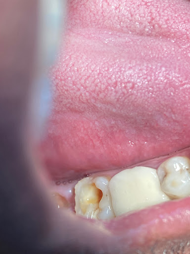 Single sitting rct post image