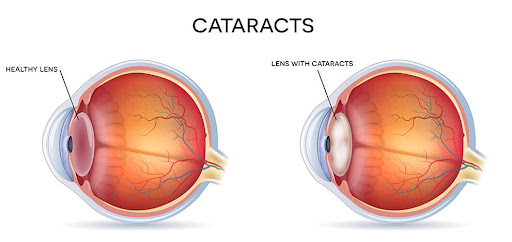 Experience exceptional cataract surgery at Aadhya Eye Hospital, the premier destination for eye c… post image