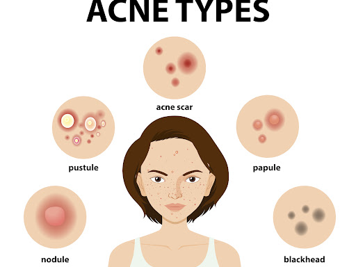 Acne is a common problem which is easily found in both men and women. There are different types o… post image