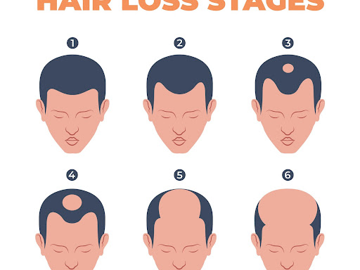 Hair loss occurs due to surrounding impact on the daily life. There are different stages of hair… post image