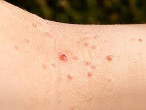 WARTS AND HOMEOPATHY post image