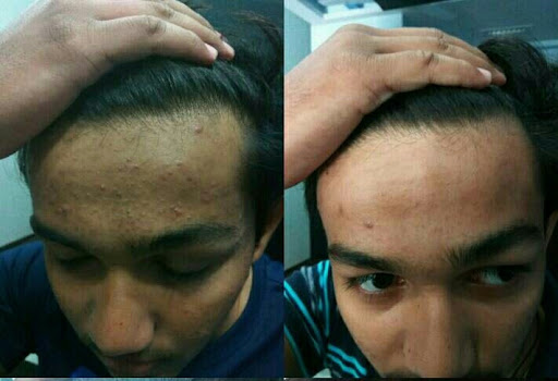 ACNE (PIMPLE) FOR HOMOEOPATHIC TREATMENT post image
