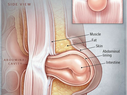 Sometimes fat or bowel can push through this defect, causing pain and a noticeable bulge. An umbi…