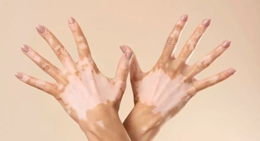 Treatment for vitiligo can vary based on the extent and progression of pigment loss. Options may… post image