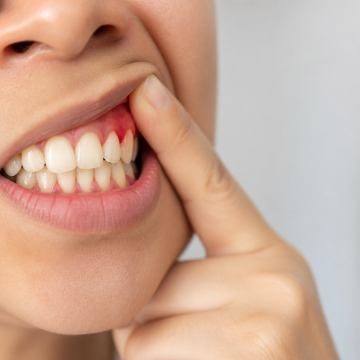 Bleeding gums are often the first warning sign of gum disease and should never be ignored. At Med… post image