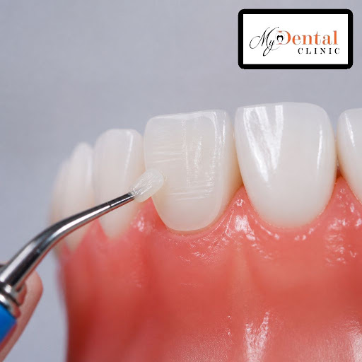 Want to fix chipped, cracked or discoloured teeth without long, complicated procedures? At My Den… post image
