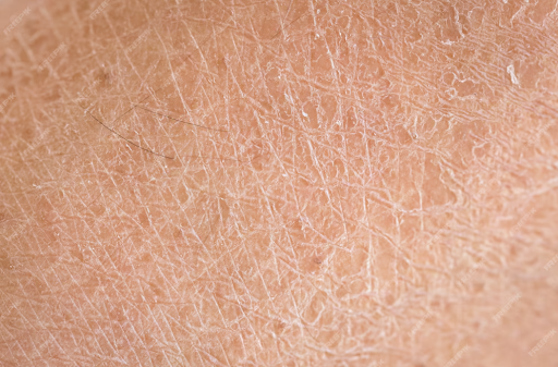 While mild scaling may sometimes improve with proper skin care, persistent or recurring symptoms… post image