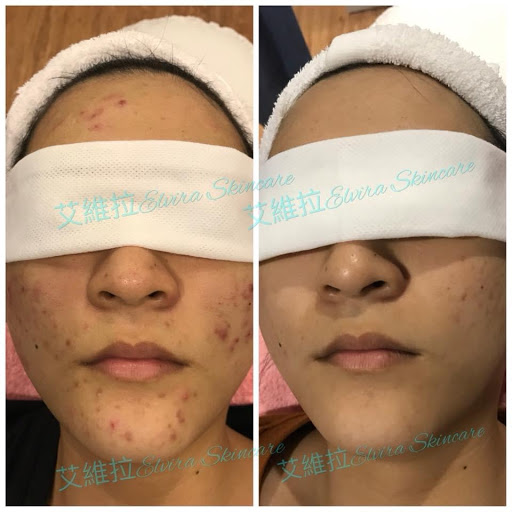 艾維拉Elvira Skincare評價、價格、網友推薦資訊 - 專業肌膚護理與清粉刺