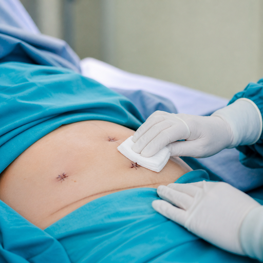 Recovering after laparoscopic cancer surgery is smoother when you know how to care for your wound… post image