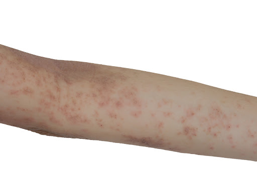 At Tanush Skin Care clinic in Bhiwandi, our dermatology specialists provide thorough assessments… post image
