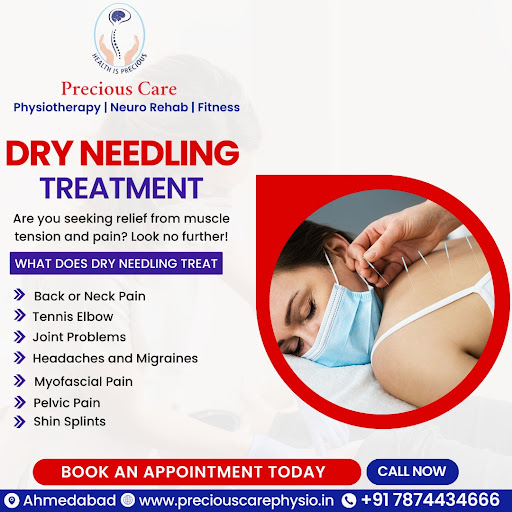 Dry needling for Pain relief.