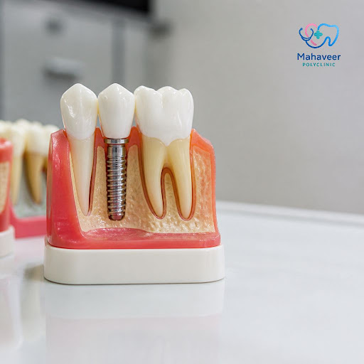 Struggling to enjoy your favourite foods because of damaged or missing teeth? At Mahaveer Polycli… post image