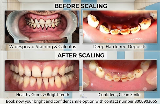 Real results for a brighter smile! 😁 Experience the difference of professional dental scaling at… post image